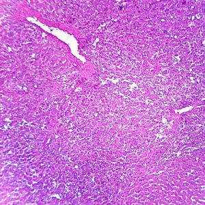 Liver with Hepatitis Slide (CBS 110)
