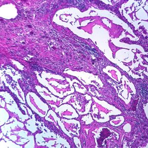 Pulmonary Edema Slide (CBS 105)